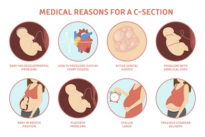 Vbac NYC - vaginal birth after cesarean NYC